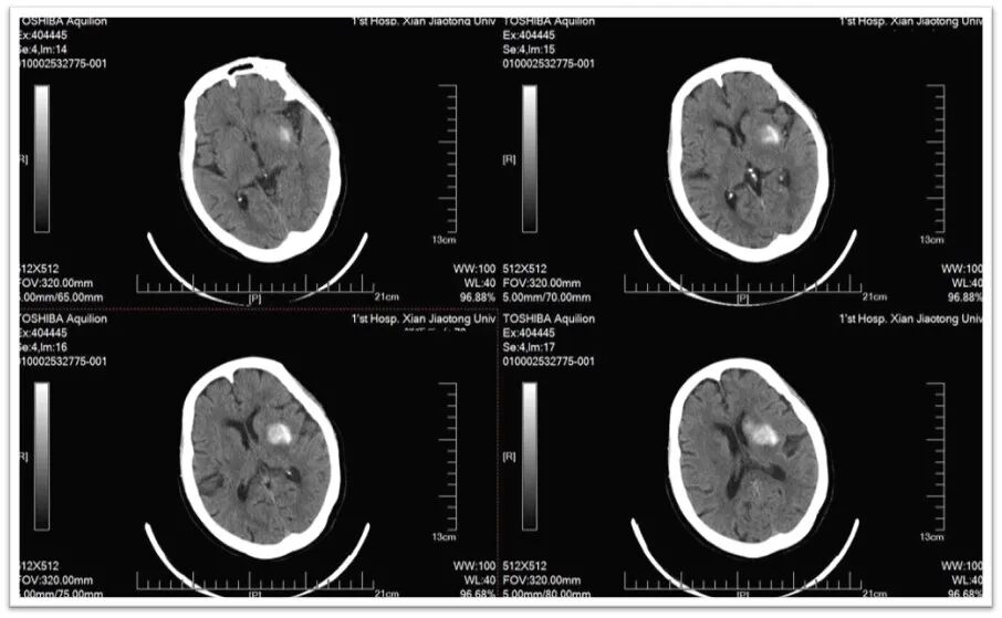 动脉长鞘怎么置入一鱼多吃，长鞘巧用抽吸术 ｜ 颈总动脉大负荷血栓取栓一例_https://www.jmylbn.com_新闻资讯_第32张
