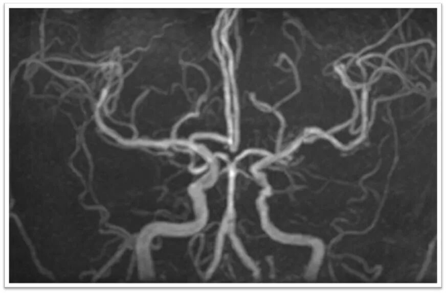 动脉长鞘怎么置入一鱼多吃，长鞘巧用抽吸术 ｜ 颈总动脉大负荷血栓取栓一例_https://www.jmylbn.com_新闻资讯_第36张