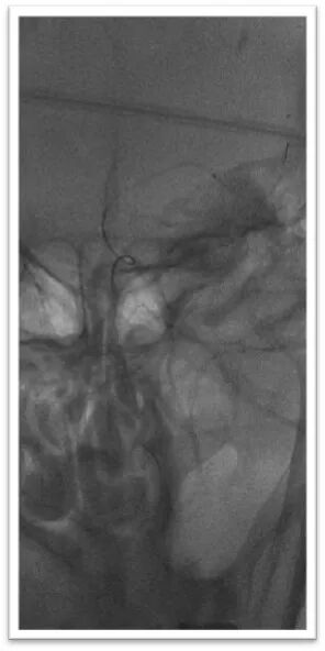 动脉长鞘怎么置入一鱼多吃，长鞘巧用抽吸术 ｜ 颈总动脉大负荷血栓取栓一例_https://www.jmylbn.com_新闻资讯_第25张