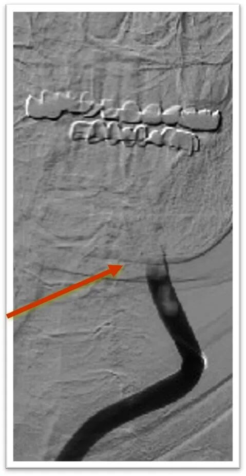 动脉长鞘怎么置入一鱼多吃，长鞘巧用抽吸术 ｜ 颈总动脉大负荷血栓取栓一例_https://www.jmylbn.com_新闻资讯_第10张