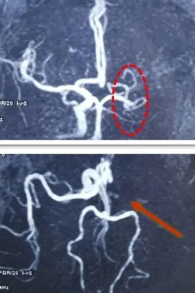 动脉长鞘怎么置入一鱼多吃，长鞘巧用抽吸术 ｜ 颈总动脉大负荷血栓取栓一例_https://www.jmylbn.com_新闻资讯_第6张