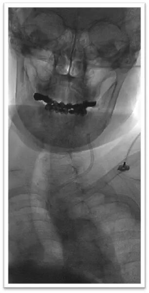 动脉长鞘怎么置入一鱼多吃，长鞘巧用抽吸术 ｜ 颈总动脉大负荷血栓取栓一例_https://www.jmylbn.com_新闻资讯_第15张