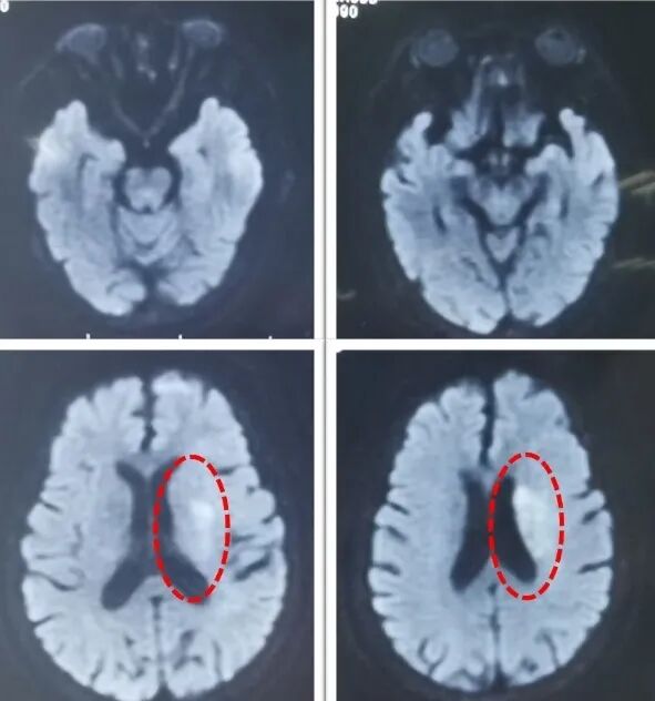 动脉长鞘怎么置入一鱼多吃，长鞘巧用抽吸术 ｜ 颈总动脉大负荷血栓取栓一例_https://www.jmylbn.com_新闻资讯_第4张