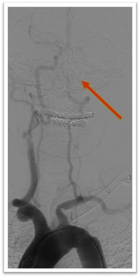 动脉长鞘怎么置入一鱼多吃，长鞘巧用抽吸术 ｜ 颈总动脉大负荷血栓取栓一例_https://www.jmylbn.com_新闻资讯_第7张