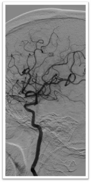 动脉长鞘怎么置入一鱼多吃，长鞘巧用抽吸术 ｜ 颈总动脉大负荷血栓取栓一例_https://www.jmylbn.com_新闻资讯_第29张