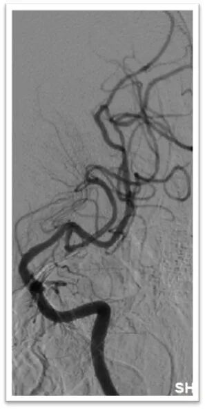 动脉长鞘怎么置入一鱼多吃，长鞘巧用抽吸术 ｜ 颈总动脉大负荷血栓取栓一例_https://www.jmylbn.com_新闻资讯_第27张