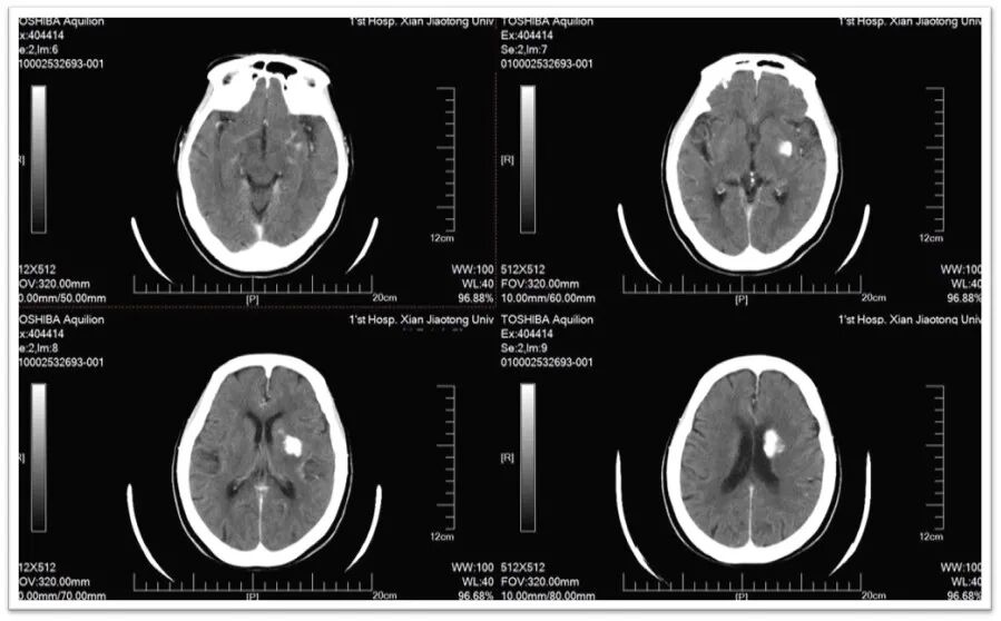 动脉长鞘怎么置入一鱼多吃，长鞘巧用抽吸术 ｜ 颈总动脉大负荷血栓取栓一例_https://www.jmylbn.com_新闻资讯_第31张