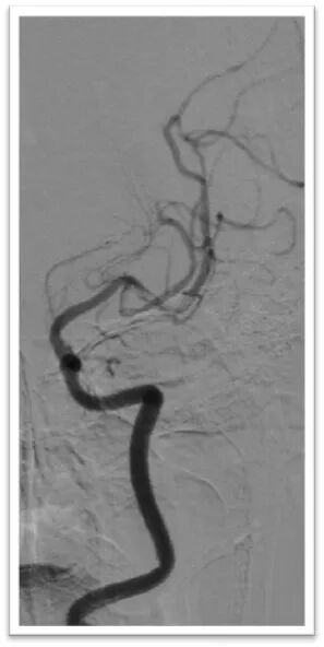 动脉长鞘怎么置入一鱼多吃，长鞘巧用抽吸术 ｜ 颈总动脉大负荷血栓取栓一例_https://www.jmylbn.com_新闻资讯_第24张