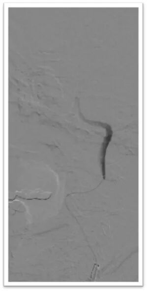 动脉长鞘怎么置入一鱼多吃，长鞘巧用抽吸术 ｜ 颈总动脉大负荷血栓取栓一例_https://www.jmylbn.com_新闻资讯_第19张