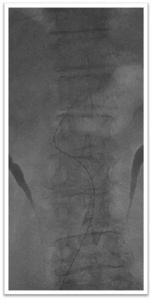 动脉长鞘怎么置入一鱼多吃，长鞘巧用抽吸术 ｜ 颈总动脉大负荷血栓取栓一例_https://www.jmylbn.com_新闻资讯_第13张