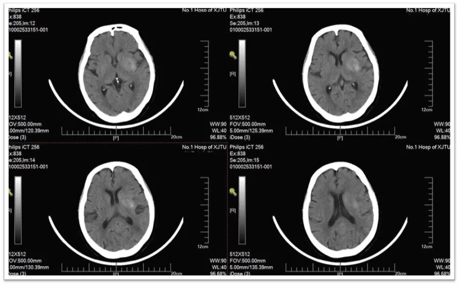 动脉长鞘怎么置入一鱼多吃，长鞘巧用抽吸术 ｜ 颈总动脉大负荷血栓取栓一例_https://www.jmylbn.com_新闻资讯_第33张