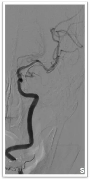 动脉长鞘怎么置入一鱼多吃，长鞘巧用抽吸术 ｜ 颈总动脉大负荷血栓取栓一例_https://www.jmylbn.com_新闻资讯_第23张