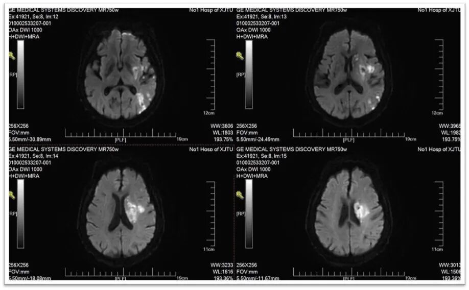 动脉长鞘怎么置入一鱼多吃，长鞘巧用抽吸术 ｜ 颈总动脉大负荷血栓取栓一例_https://www.jmylbn.com_新闻资讯_第34张