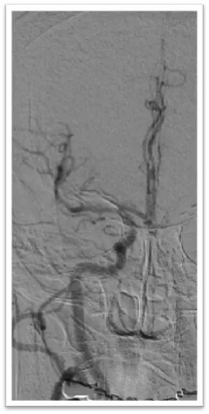 动脉长鞘怎么置入一鱼多吃，长鞘巧用抽吸术 ｜ 颈总动脉大负荷血栓取栓一例_https://www.jmylbn.com_新闻资讯_第8张