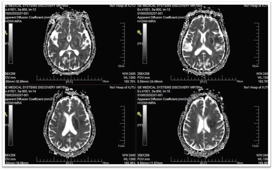 动脉长鞘怎么置入一鱼多吃，长鞘巧用抽吸术 ｜ 颈总动脉大负荷血栓取栓一例_https://www.jmylbn.com_新闻资讯_第35张