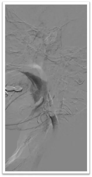 动脉长鞘怎么置入一鱼多吃，长鞘巧用抽吸术 ｜ 颈总动脉大负荷血栓取栓一例_https://www.jmylbn.com_新闻资讯_第18张