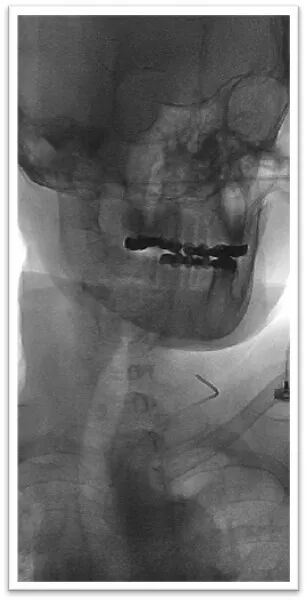 动脉长鞘怎么置入一鱼多吃，长鞘巧用抽吸术 ｜ 颈总动脉大负荷血栓取栓一例_https://www.jmylbn.com_新闻资讯_第14张