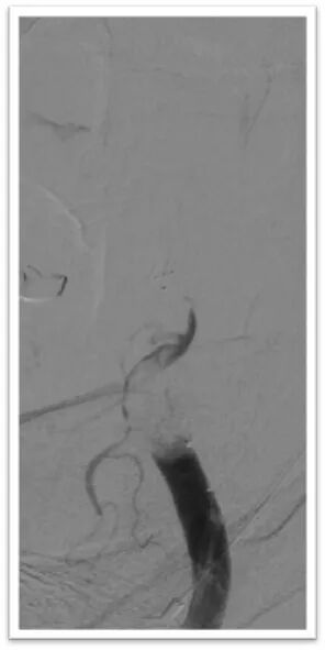 动脉长鞘怎么置入一鱼多吃，长鞘巧用抽吸术 ｜ 颈总动脉大负荷血栓取栓一例_https://www.jmylbn.com_新闻资讯_第21张