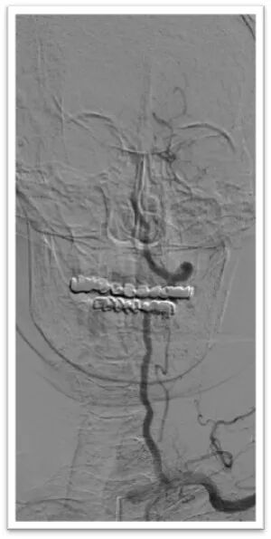 动脉长鞘怎么置入一鱼多吃，长鞘巧用抽吸术 ｜ 颈总动脉大负荷血栓取栓一例_https://www.jmylbn.com_新闻资讯_第9张