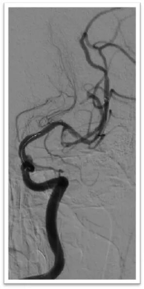 动脉长鞘怎么置入一鱼多吃，长鞘巧用抽吸术 ｜ 颈总动脉大负荷血栓取栓一例_https://www.jmylbn.com_新闻资讯_第26张
