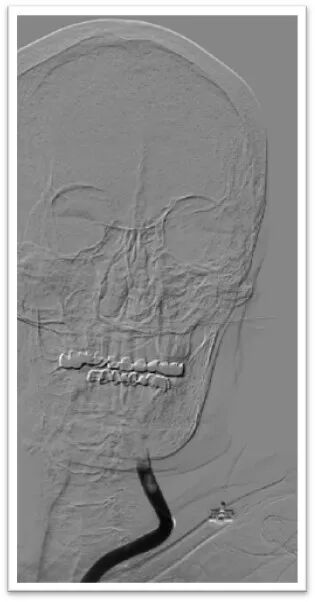 动脉长鞘怎么置入一鱼多吃，长鞘巧用抽吸术 ｜ 颈总动脉大负荷血栓取栓一例_https://www.jmylbn.com_新闻资讯_第16张