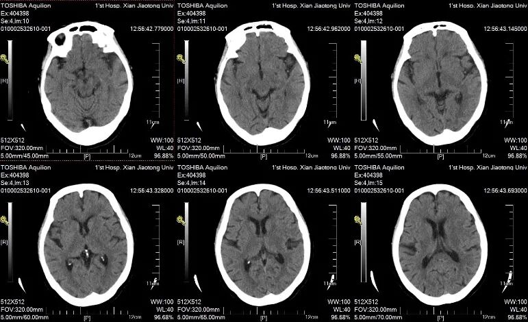 动脉长鞘怎么置入一鱼多吃，长鞘巧用抽吸术 ｜ 颈总动脉大负荷血栓取栓一例_https://www.jmylbn.com_新闻资讯_第3张