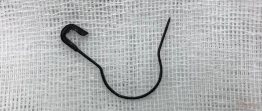 开口的别针卡进气管一个月，11个月宝宝险丧命！医生：这种手术一年要做500个