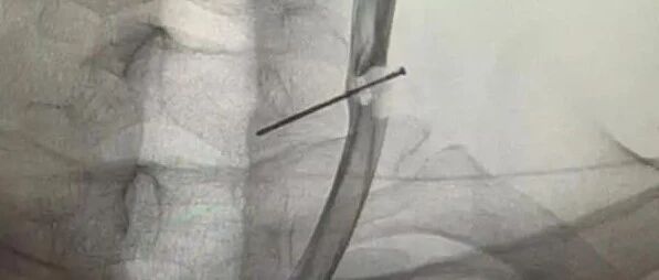 奇！3厘米长钉穿透颈动脉10多年，浙江男子竟毫无察觉……