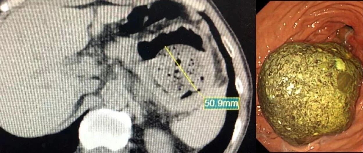 浙江男子爱吃一种水果，体内长出“金色巨石”！医生20多次没取完……