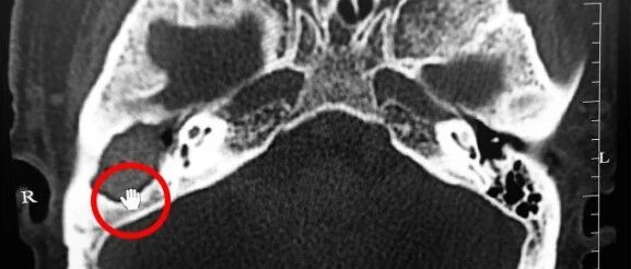 可怕！男子掏耳朵竟然掏出个……差点要命！医生紧急提醒