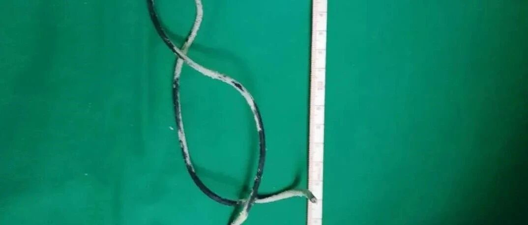 尿液从哪来的？13岁男孩用70厘米长电线一探究竟，结果悲剧了……