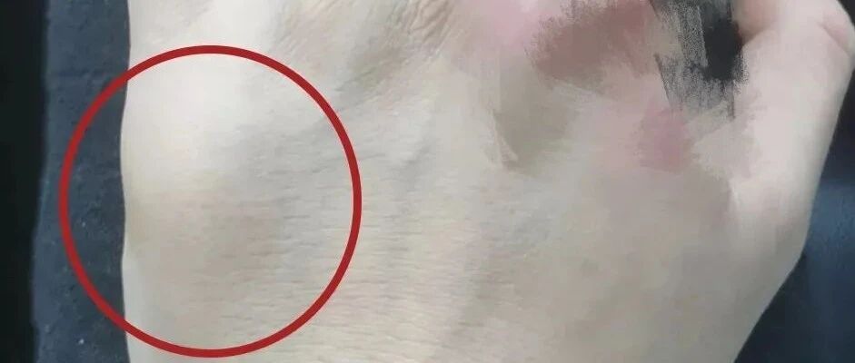 手背鼓起大包，程序员错认7年的“键盘手”，一查竟是瘤！里面满满“豆腐渣”……