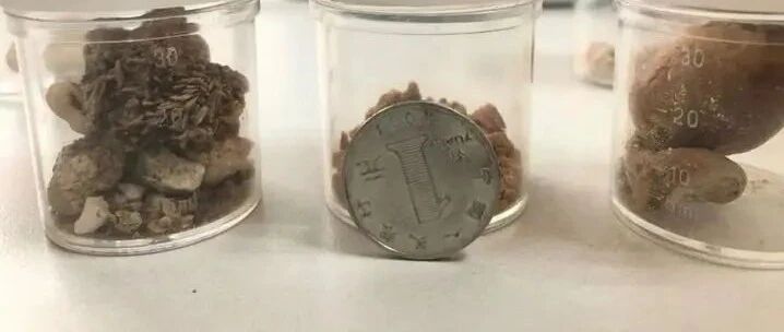 1岁宝宝持续2周反复高烧40℃，罪魁祸首竟是两颗结石！医生：还有更小的宝宝……