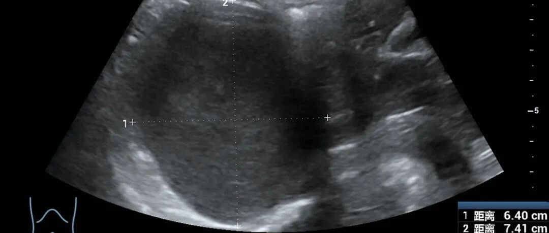 每次来月经都痛得死去活来！23岁女生身体里竟抽出“巧克力”……