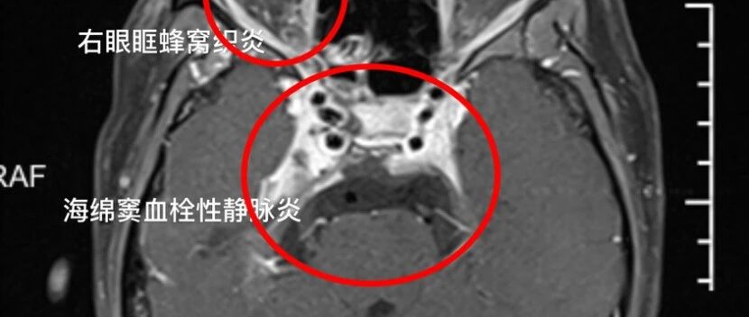 19岁女孩颅内感染！这件事很多人都爱做，网友：原来我真的命大......