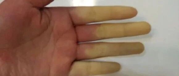 拿了一下冻鱼，杭州女子手指突然变惨白！还感到“刺骨”的冷…… ​