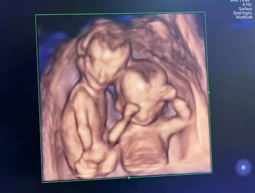 汕头彩超怎么样四维小科普 4 问 4 答，你不清楚的都在这篇推文里！『汕头市妇产医院』_https://www.jmylbn.com_新闻资讯_第13张