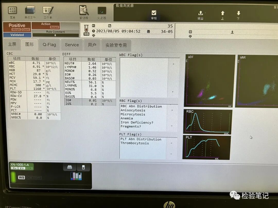 rbc直方图怎么看“实战演练”——用血常规散点图判断异常结果_https://www.jmylbn.com_新闻资讯_第21张