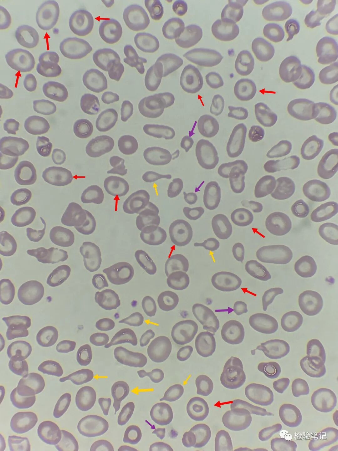 rbc直方图怎么看“实战演练”——用血常规散点图判断异常结果_https://www.jmylbn.com_新闻资讯_第24张