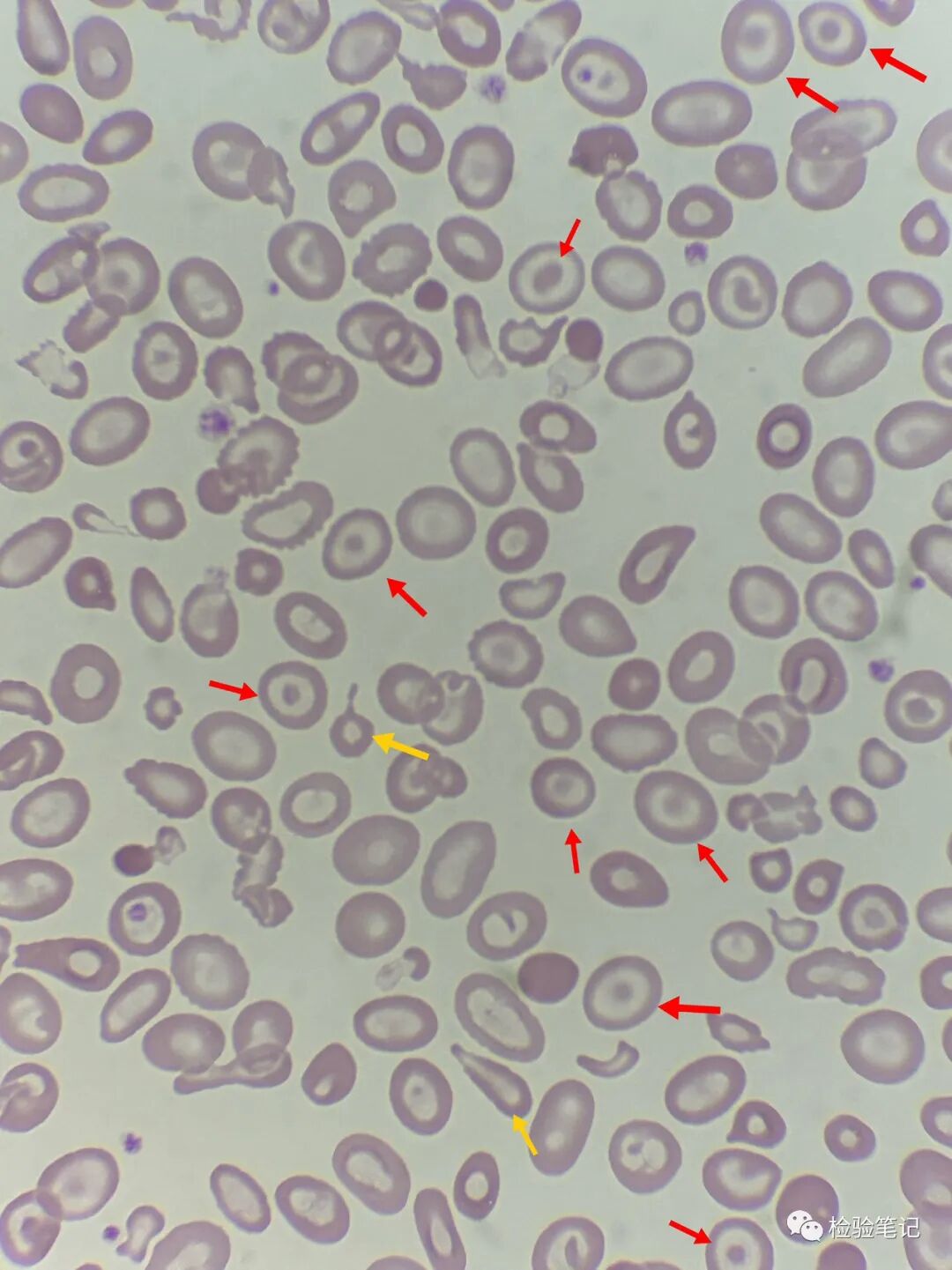 rbc直方图怎么看“实战演练”——用血常规散点图判断异常结果_https://www.jmylbn.com_新闻资讯_第27张