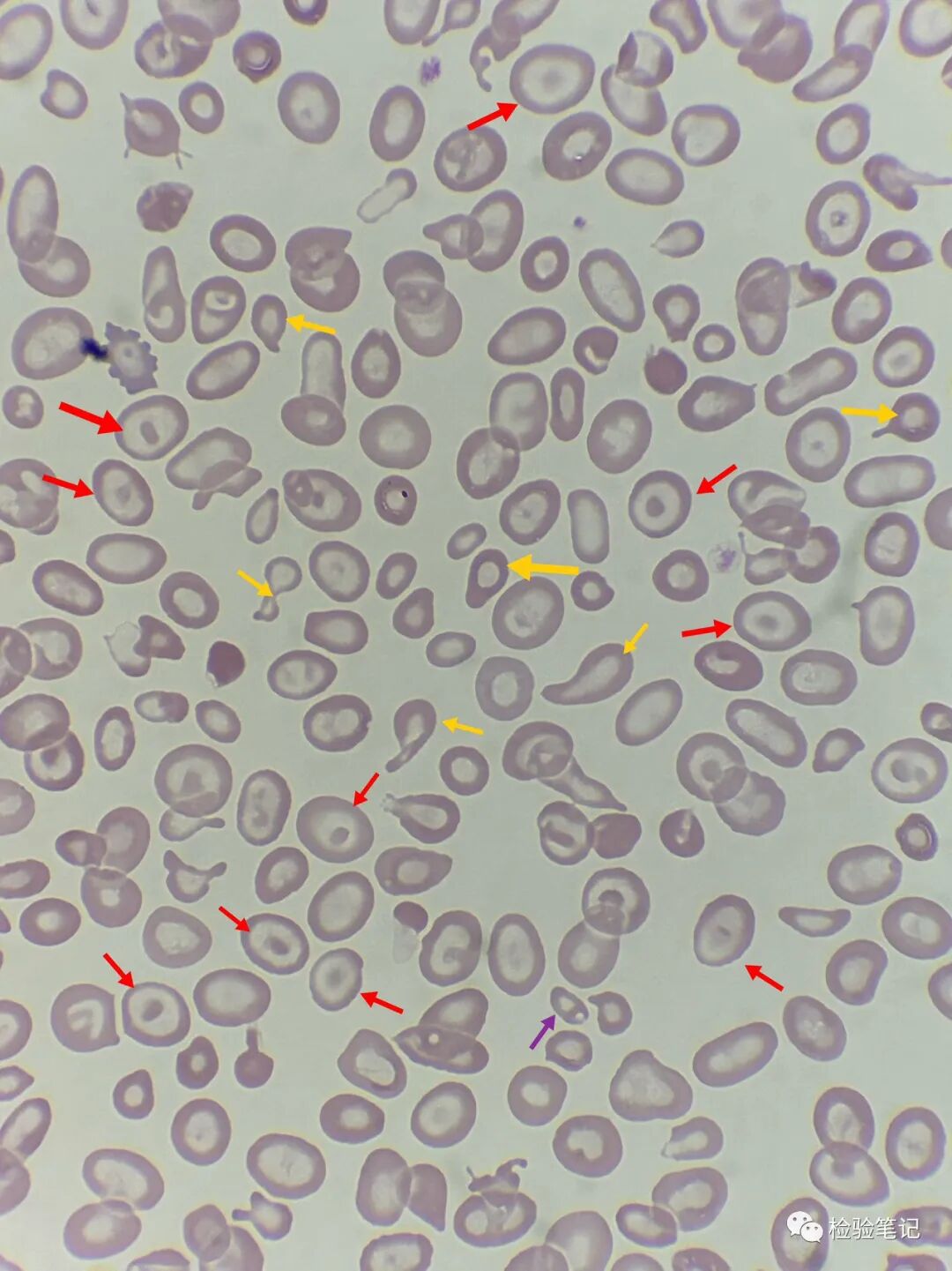 rbc直方图怎么看“实战演练”——用血常规散点图判断异常结果_https://www.jmylbn.com_新闻资讯_第25张