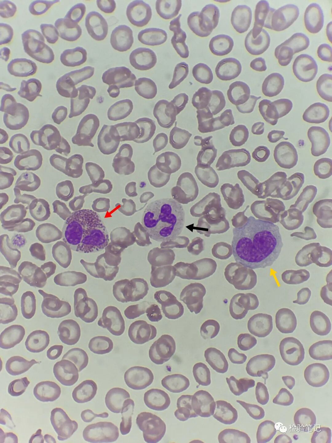 rbc直方图怎么看“实战演练”——用血常规散点图判断异常结果_https://www.jmylbn.com_新闻资讯_第26张