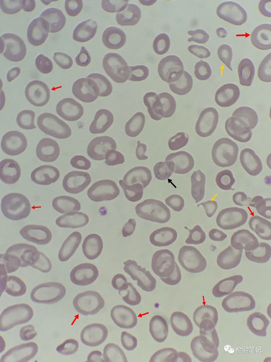 rbc直方图怎么看“实战演练”——用血常规散点图判断异常结果_https://www.jmylbn.com_新闻资讯_第23张
