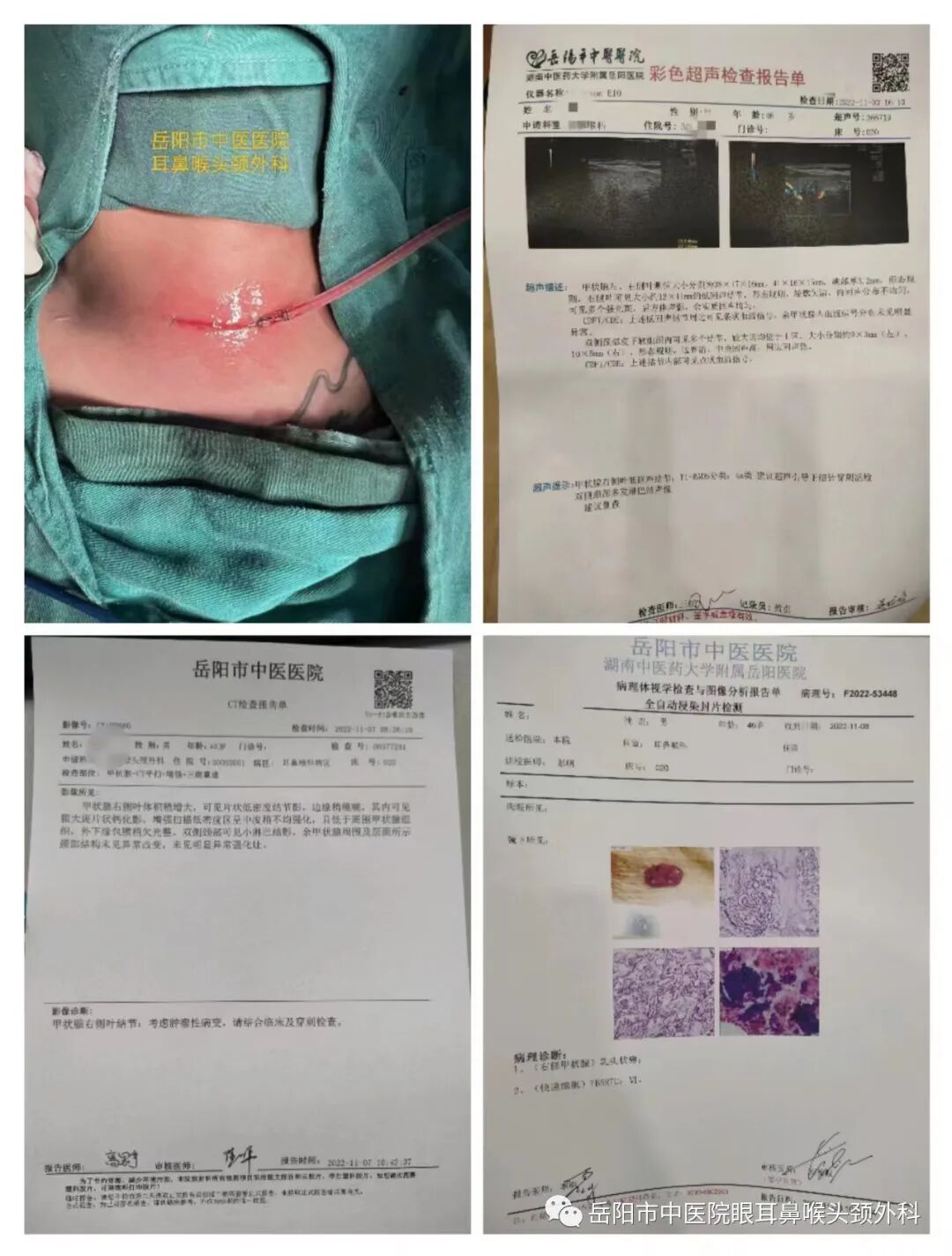 医讯怎么用【医讯】甲状腺结节可以用中医药调理吗？_https://www.jmylbn.com_新闻资讯_第3张