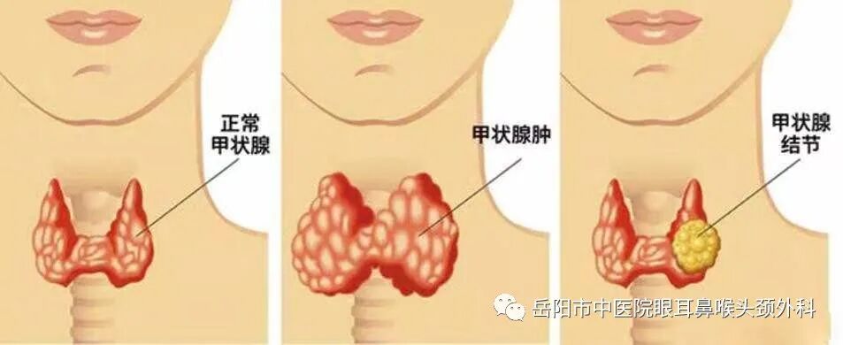 医讯怎么用【医讯】甲状腺结节可以用中医药调理吗？_https://www.jmylbn.com_新闻资讯_第2张