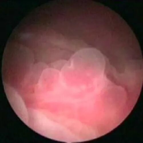 b膀胱镜为什么消毒为什么医生建议你查膀胱镜？附：检查前后注意事项_https://www.jmylbn.com_新闻资讯_第4张