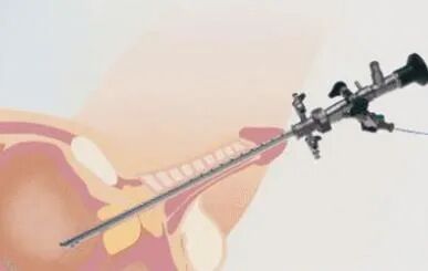 b膀胱镜为什么消毒为什么医生建议你查膀胱镜？附：检查前后注意事项_https://www.jmylbn.com_新闻资讯_第2张