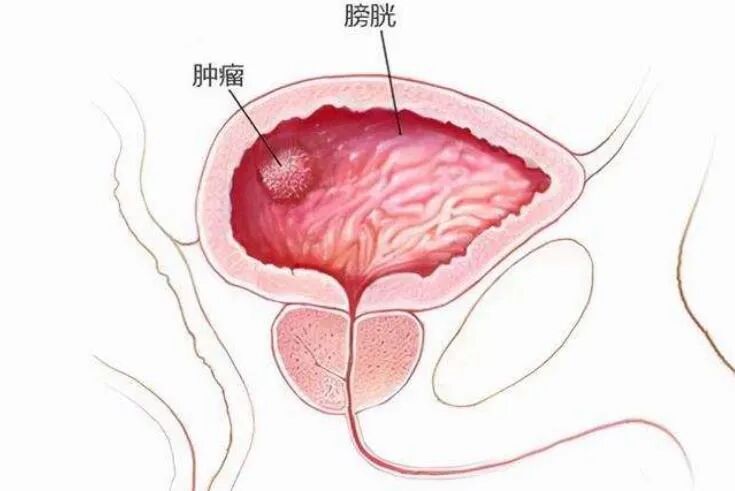 b膀胱镜为什么消毒为什么医生建议你查膀胱镜？附：检查前后注意事项_https://www.jmylbn.com_新闻资讯_第6张