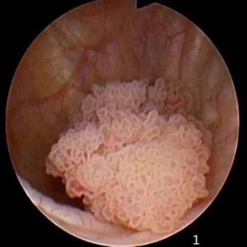 b膀胱镜为什么消毒为什么医生建议你查膀胱镜？附：检查前后注意事项_https://www.jmylbn.com_新闻资讯_第5张