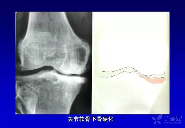 医学术语 Arthrosclerosis 医学英语词汇 微信公众号文章阅读 Wemp